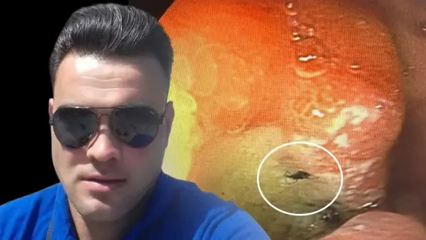 Mide ağrısıyla hastaneye gitmişti: Midesinden canlı böcek çıktı